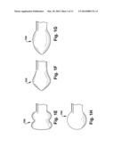 SURGICAL TECHNIQUE(S) AND/OR DEVICE(S) diagram and image