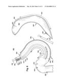 SURGICAL TECHNIQUE(S) AND/OR DEVICE(S) diagram and image