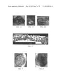 SYSTEM FOR PERCUTANEOUSLY ADMINISTERING REDUCED PRESSURE TREATMENT USING     BALLOON DISSECTION diagram and image