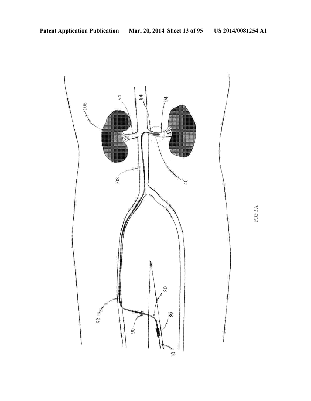 COOLED MICROWAVE DENERVATION - diagram, schematic, and image 14