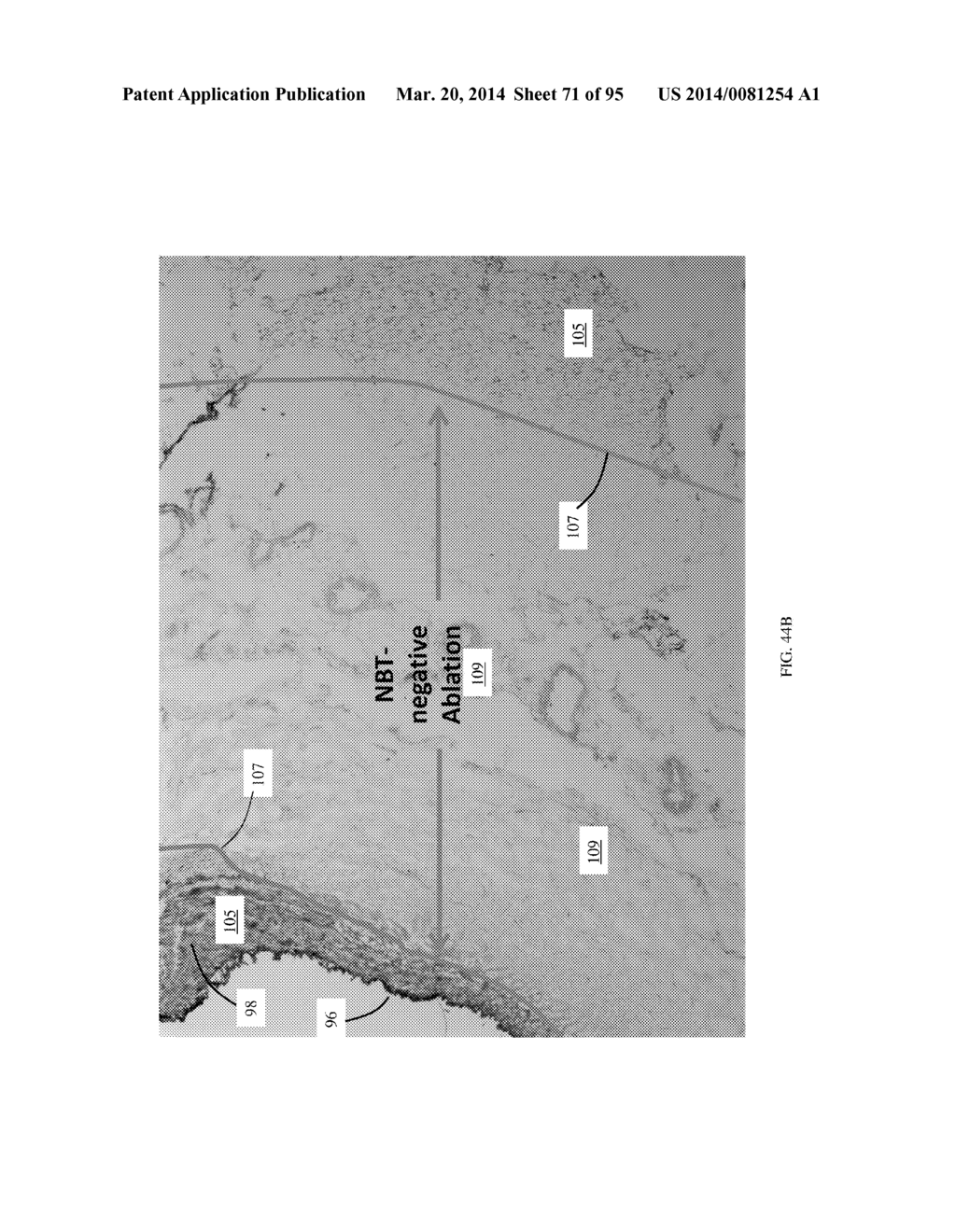 COOLED MICROWAVE DENERVATION - diagram, schematic, and image 72