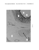 COOLED MICROWAVE DENERVATION diagram and image