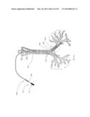 COOLED MICROWAVE DENERVATION diagram and image