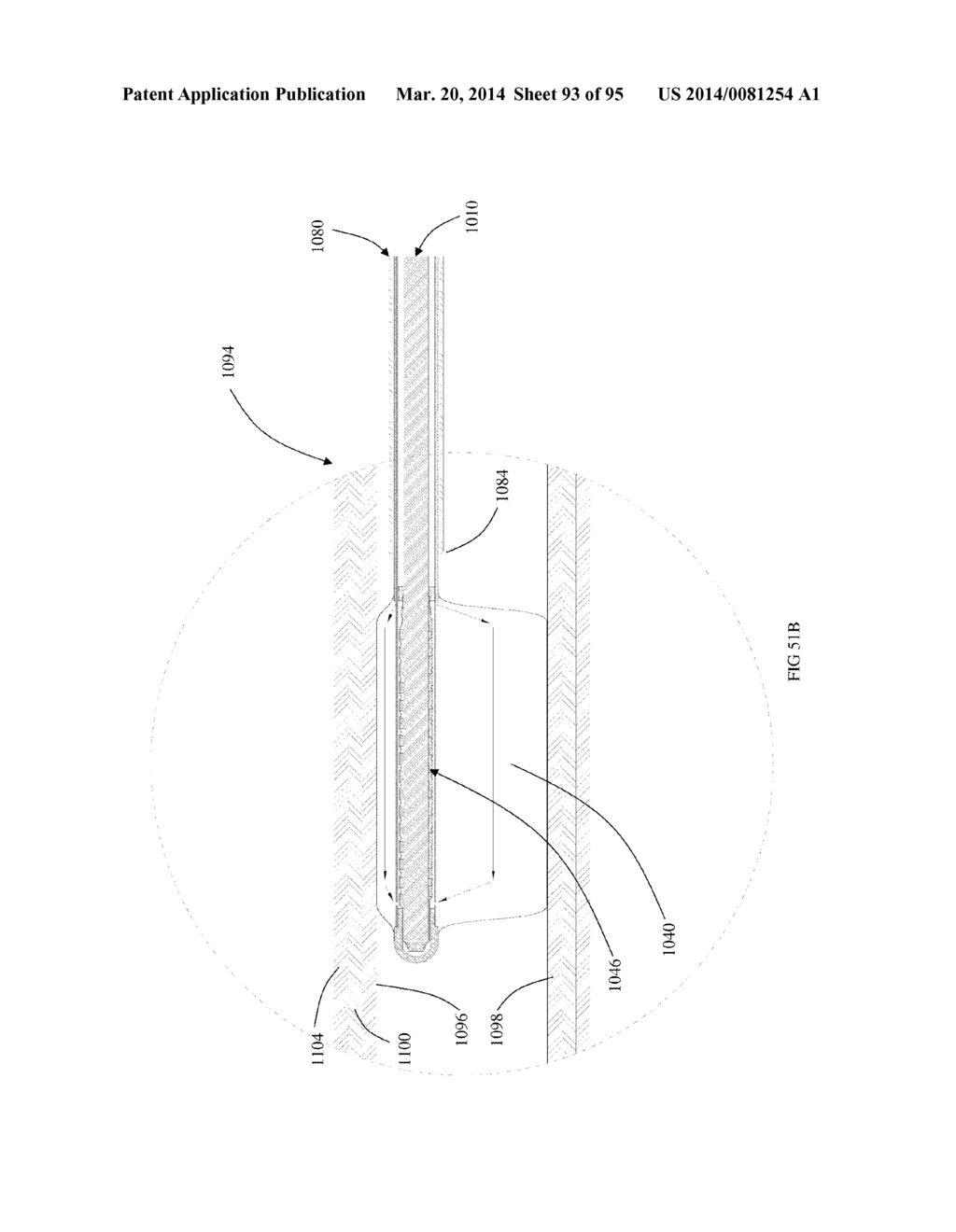 COOLED MICROWAVE DENERVATION - diagram, schematic, and image 94