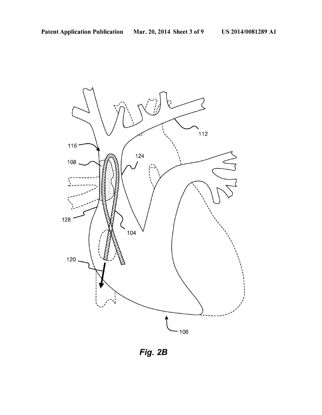 LEAD REMOVAL SLEEVE - diagram, schematic, and image 04