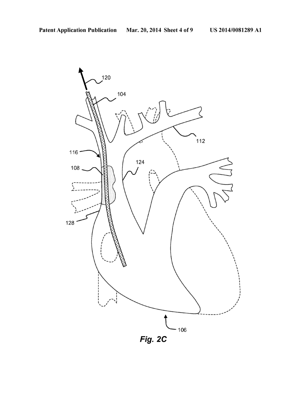 LEAD REMOVAL SLEEVE - diagram, schematic, and image 05