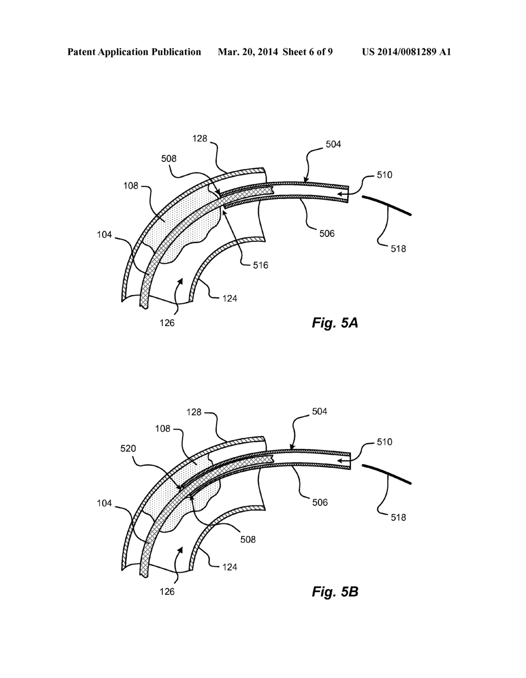 LEAD REMOVAL SLEEVE - diagram, schematic, and image 07