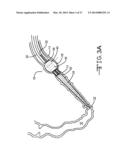 ENDOLUMENAL RESTRICTION METHOD AND APPARATUS diagram and image