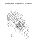 ENDOLUMENAL RESTRICTION METHOD AND APPARATUS diagram and image