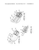 ENDOLUMENAL RESTRICTION METHOD AND APPARATUS diagram and image