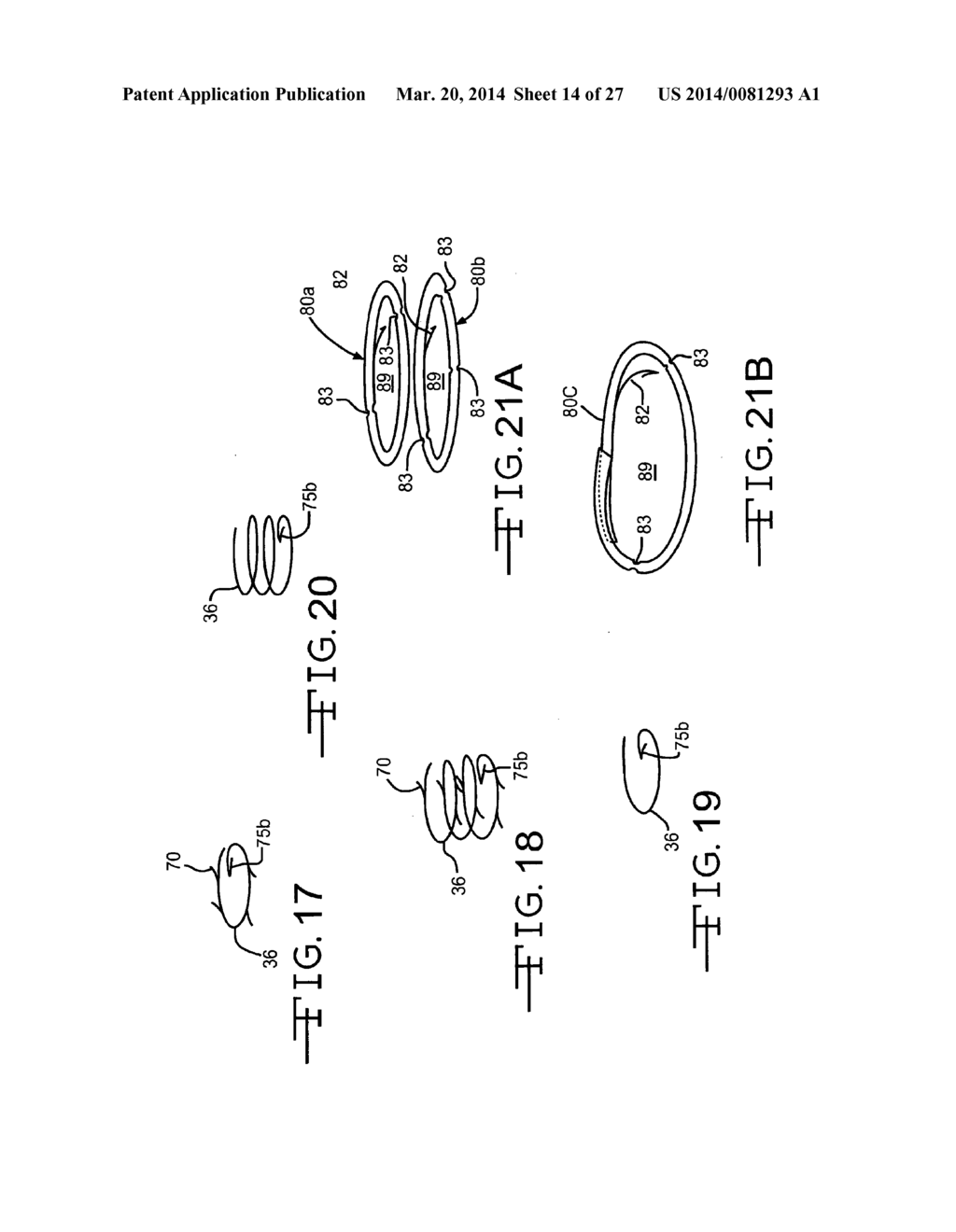 ENDOLUMENAL RESTRICTION METHOD AND APPARATUS - diagram, schematic, and image 15