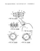 ENDOLUMENAL RESTRICTION METHOD AND APPARATUS diagram and image