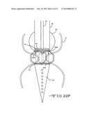 ENDOLUMENAL RESTRICTION METHOD AND APPARATUS diagram and image