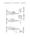 ENDOLUMENAL RESTRICTION METHOD AND APPARATUS diagram and image