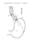 ENDOLUMENAL RESTRICTION METHOD AND APPARATUS diagram and image