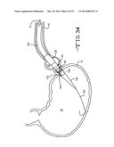 ENDOLUMENAL RESTRICTION METHOD AND APPARATUS diagram and image