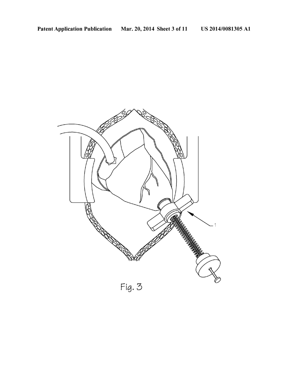 Hollow Organ Coring Tool with Collapsing Anvil and Method of Use - diagram, schematic, and image 04