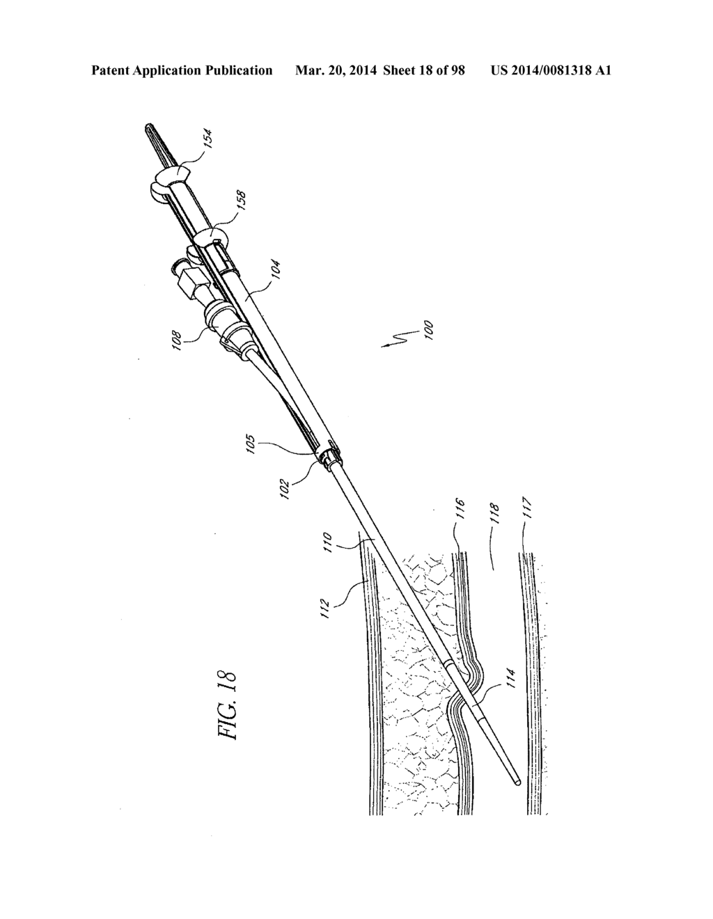 TISSUE CLOSURE DEVICES, DEVICE AND SYSTEMS FOR DELIVERY, KITS AND METHODS     THEREFOR - diagram, schematic, and image 19