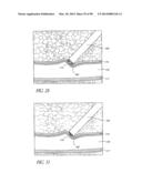 TISSUE CLOSURE DEVICES, DEVICE AND SYSTEMS FOR DELIVERY, KITS AND METHODS     THEREFOR diagram and image