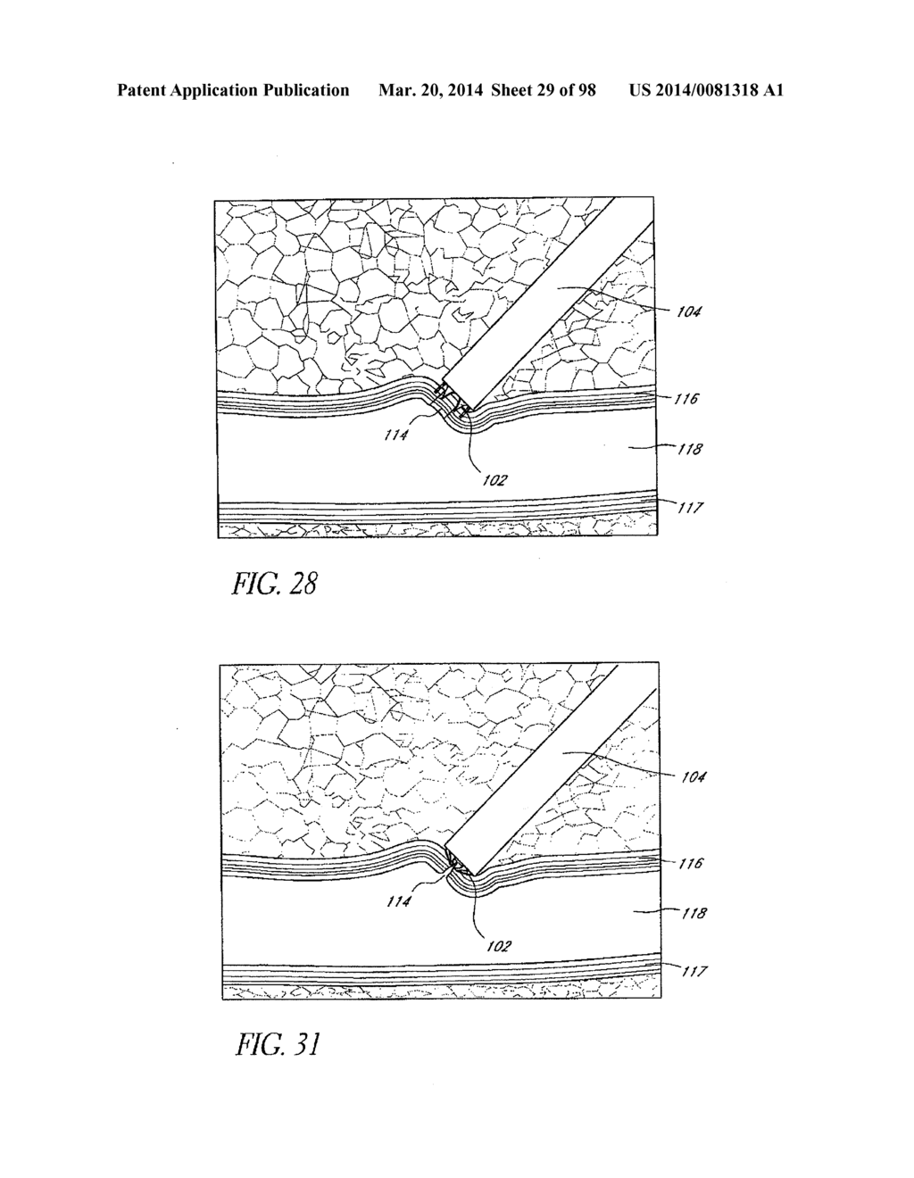 TISSUE CLOSURE DEVICES, DEVICE AND SYSTEMS FOR DELIVERY, KITS AND METHODS     THEREFOR - diagram, schematic, and image 30