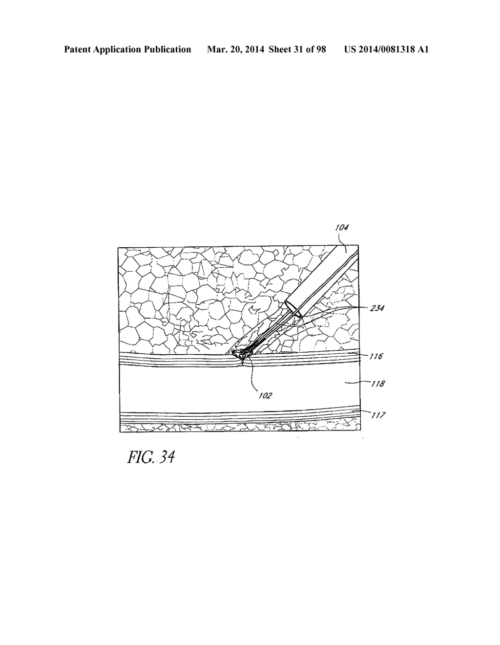 TISSUE CLOSURE DEVICES, DEVICE AND SYSTEMS FOR DELIVERY, KITS AND METHODS     THEREFOR - diagram, schematic, and image 32