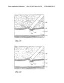 TISSUE CLOSURE DEVICES, DEVICE AND SYSTEMS FOR DELIVERY, KITS AND METHODS     THEREFOR diagram and image