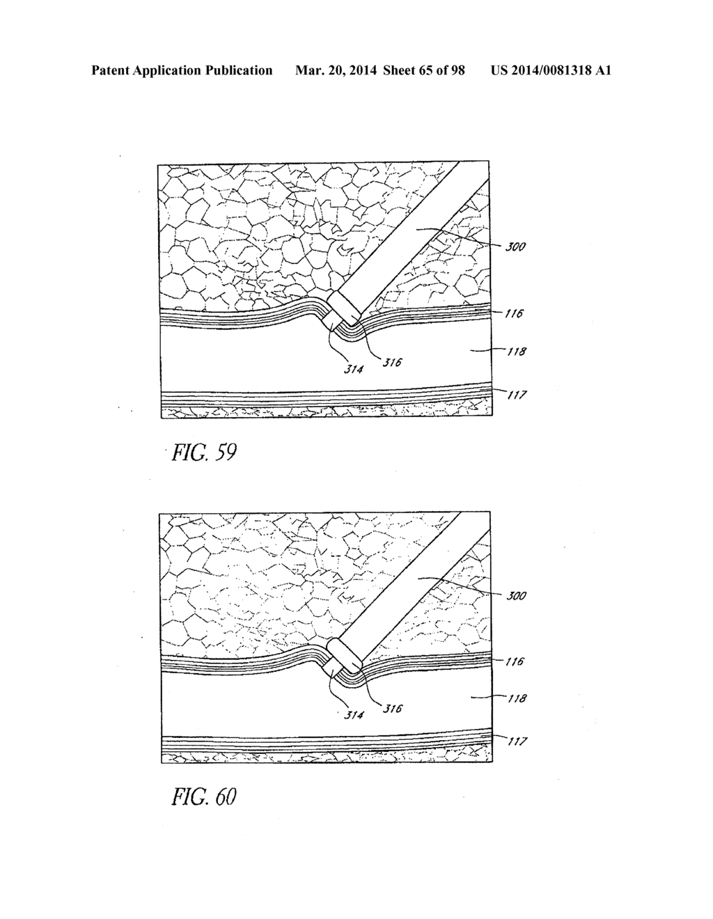 TISSUE CLOSURE DEVICES, DEVICE AND SYSTEMS FOR DELIVERY, KITS AND METHODS     THEREFOR - diagram, schematic, and image 66