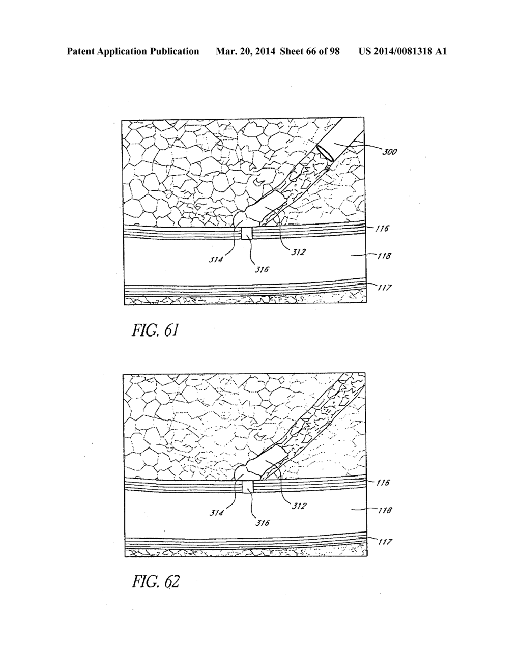 TISSUE CLOSURE DEVICES, DEVICE AND SYSTEMS FOR DELIVERY, KITS AND METHODS     THEREFOR - diagram, schematic, and image 67