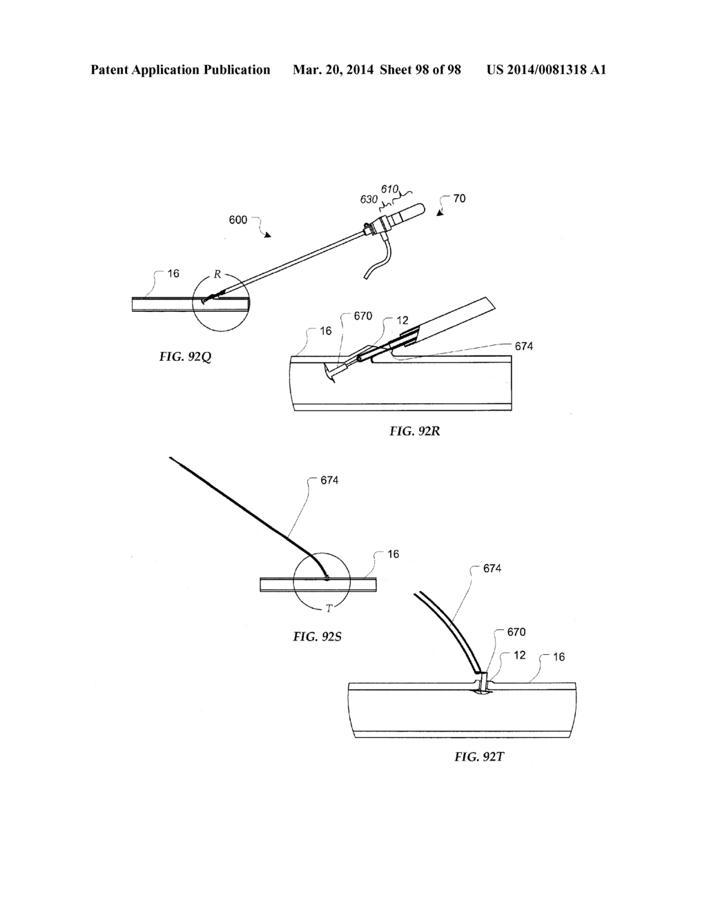 TISSUE CLOSURE DEVICES, DEVICE AND SYSTEMS FOR DELIVERY, KITS AND METHODS     THEREFOR - diagram, schematic, and image 99