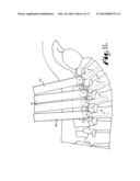 Dynamic stabilization medical implant assembles and methods diagram and image