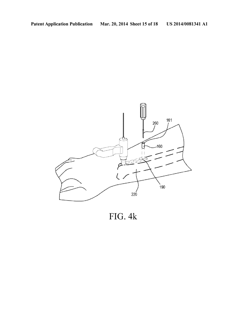 BONE FIXATION GUIDE DEVICE - diagram, schematic, and image 16