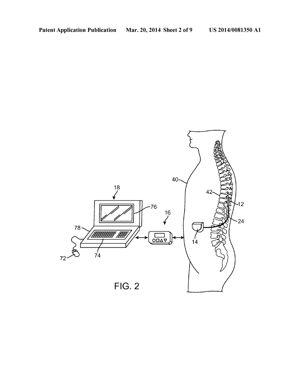 METHOD FOR ESTIMATING DESIRED STIMULATION AMPLITUDE FOR ELECTRODE     CONFIGURATION - diagram, schematic, and image 03