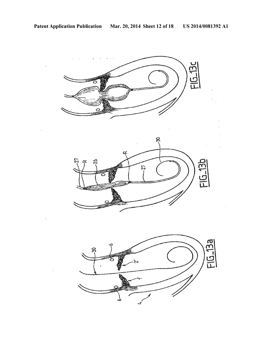 COLLAPSIBLE PROSTHETIC VALVE HAVING AN INTERNAL COVER - diagram, schematic, and image 13