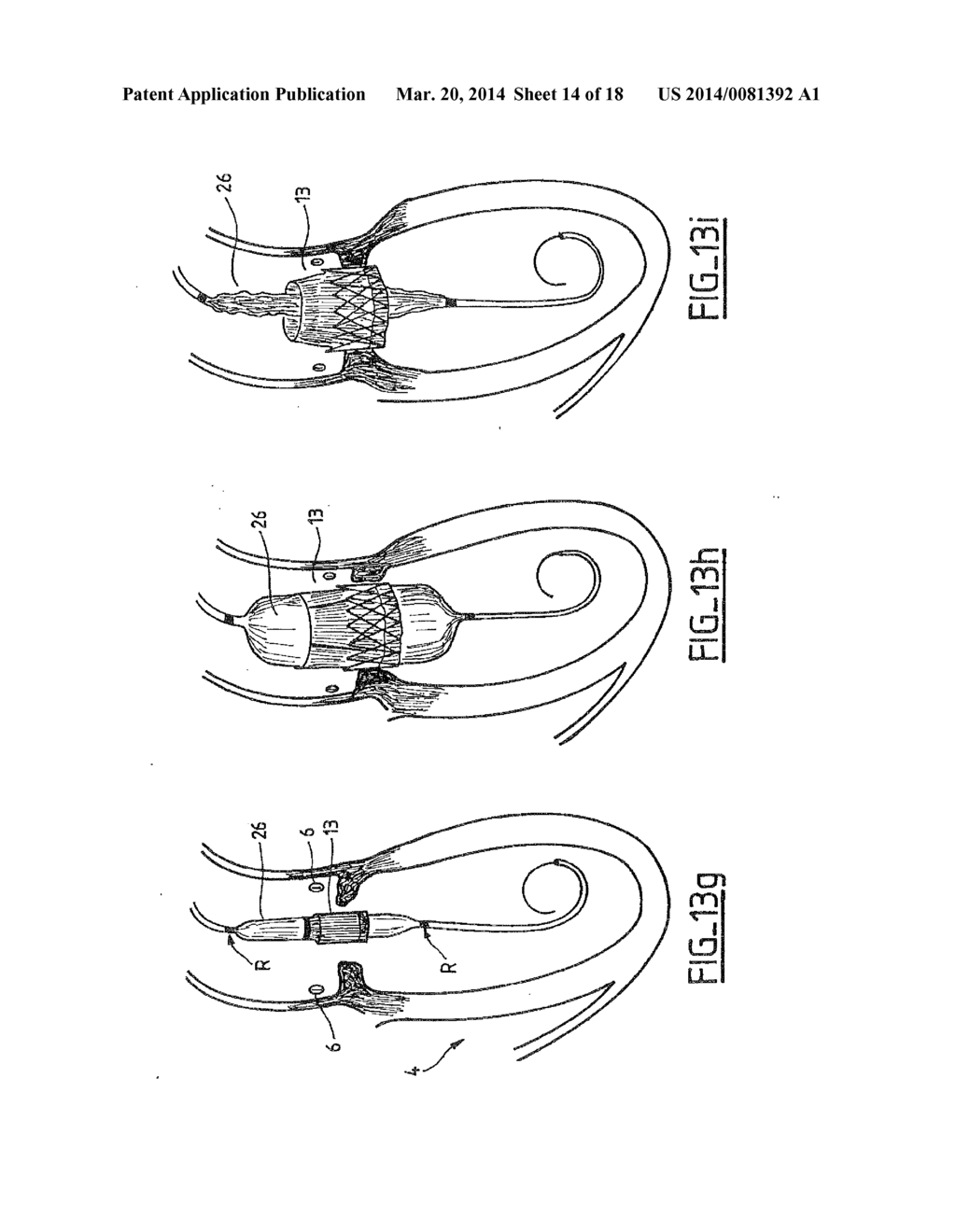 COLLAPSIBLE PROSTHETIC VALVE HAVING AN INTERNAL COVER - diagram, schematic, and image 15