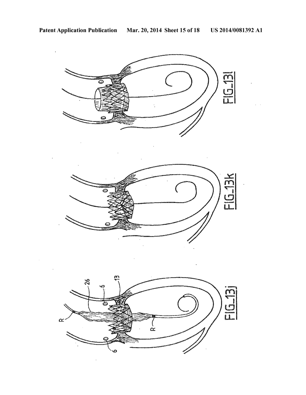 COLLAPSIBLE PROSTHETIC VALVE HAVING AN INTERNAL COVER - diagram, schematic, and image 16