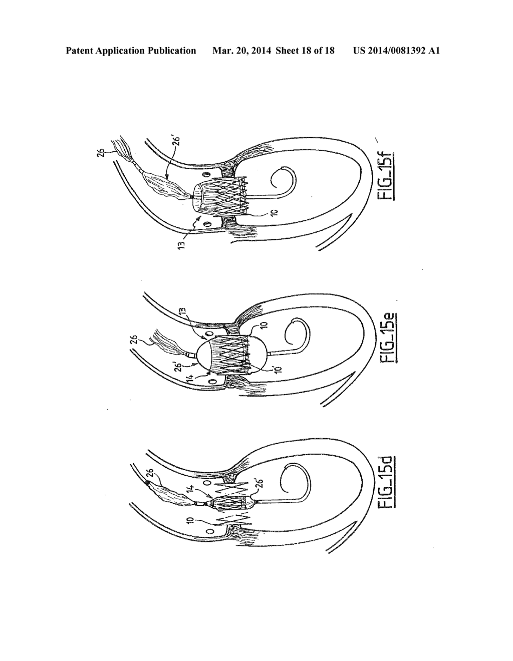 COLLAPSIBLE PROSTHETIC VALVE HAVING AN INTERNAL COVER - diagram, schematic, and image 19
