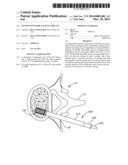 NESTED EXPANDABLE SLEEVE IMPLANT diagram and image