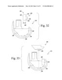 FEMORAL KNEE PROSTHESIS SYSTEM WITH AUGMENTS AND MULTIPLE LENGTHS OF     SLEEVES SHARING A COMMON GEOMETRY diagram and image