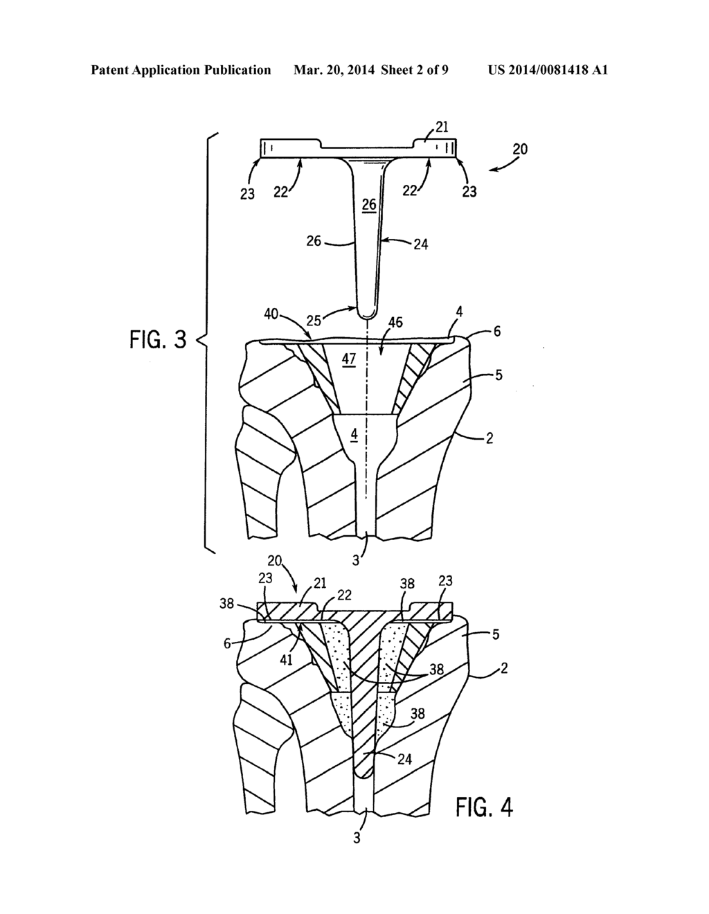 PROSTHETIC IMPLANT SUPPORT STRUCTURE - diagram, schematic, and image 03