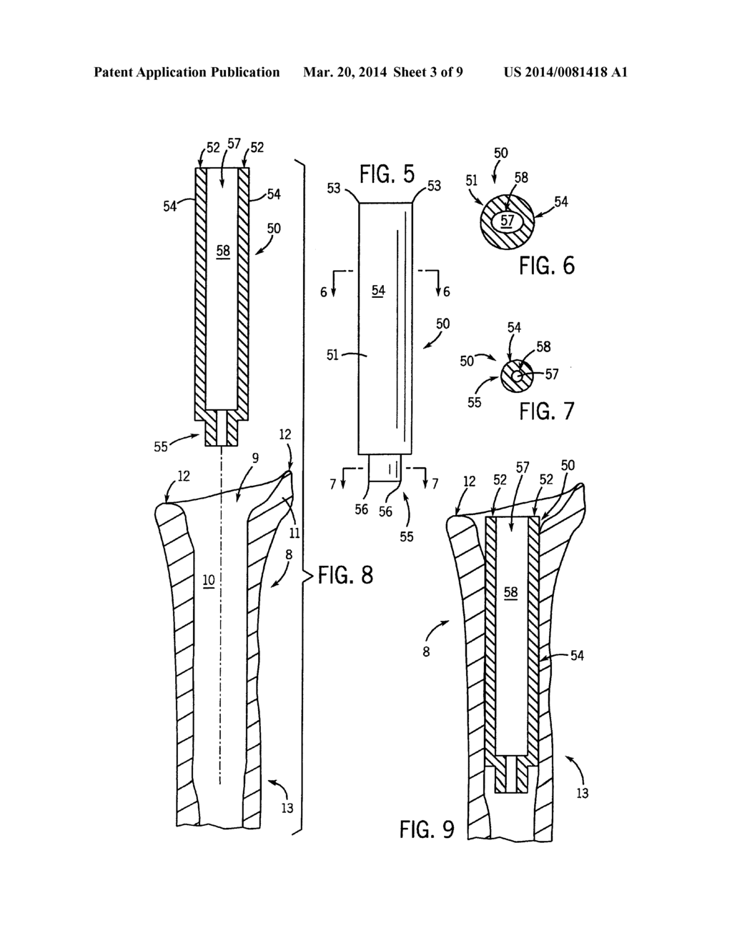 PROSTHETIC IMPLANT SUPPORT STRUCTURE - diagram, schematic, and image 04