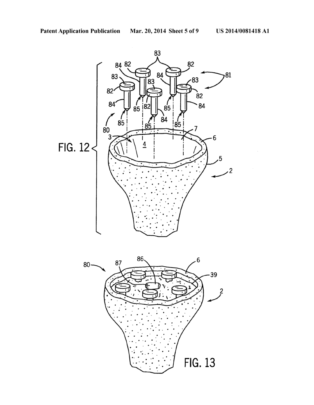 PROSTHETIC IMPLANT SUPPORT STRUCTURE - diagram, schematic, and image 06