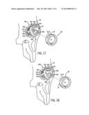 PROSTHETIC IMPLANT SUPPORT STRUCTURE diagram and image