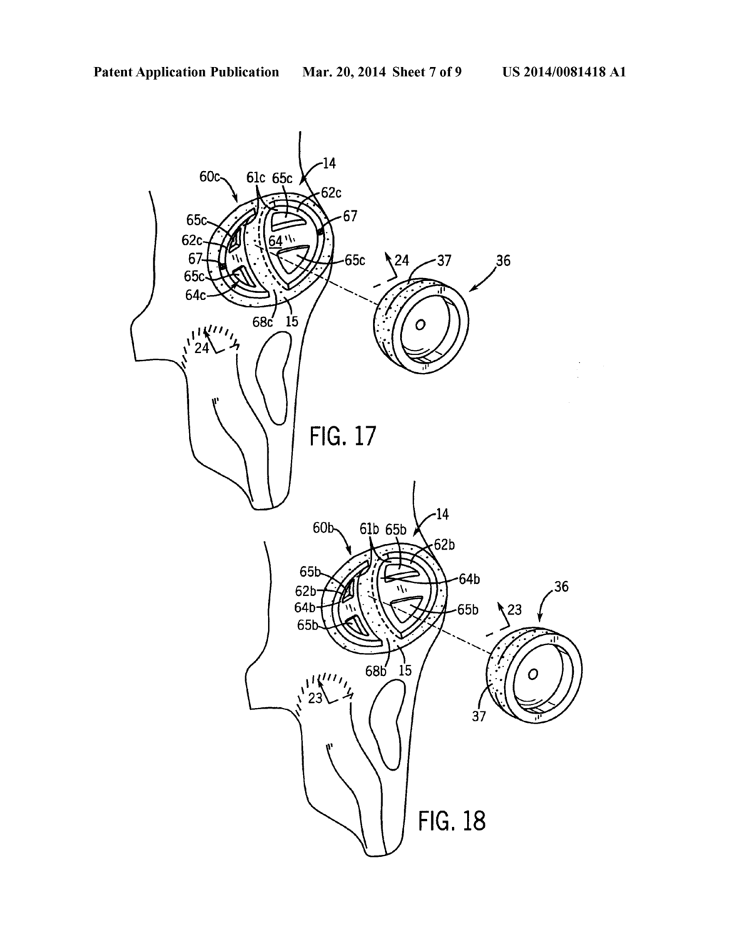 PROSTHETIC IMPLANT SUPPORT STRUCTURE - diagram, schematic, and image 08