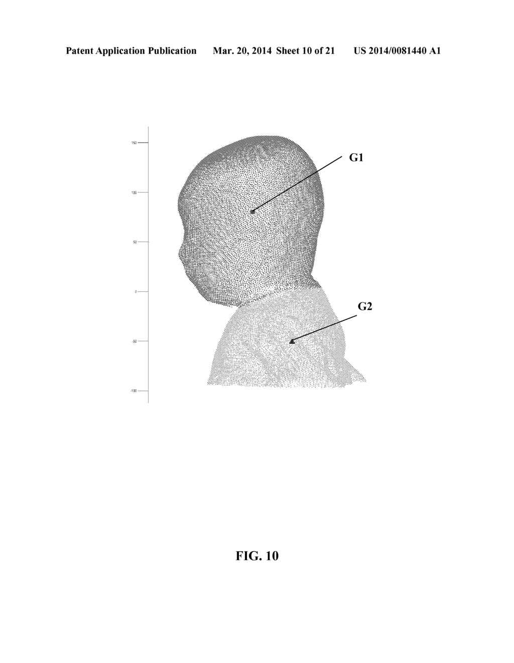 METHOD AND APPARATUS FOR AUTOMATICALLY GENERATING TRIM LINES FOR CRANIAL     REMODELING DEVICES - diagram, schematic, and image 11