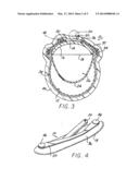 STABLE AORTIC BLOOD PUMP IMPLANT diagram and image