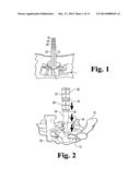 OVER DILATION diagram and image