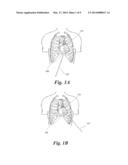 METHOD FOR PUNCTURING THE PERICARDIAL MEMBRANE BY SYNCHRONIZING NEEDLE     ADVANCEMENT WITH CARDIAC MUSCLE MOTION diagram and image