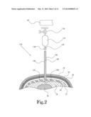 Instrument Penetration Detector Using Dynamic Frequency Adjustment, and     Method of Operation diagram and image