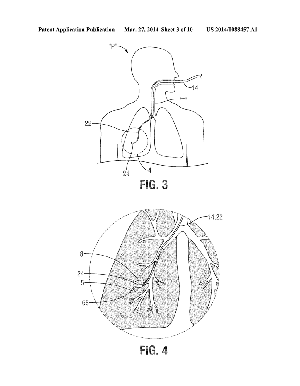 BLEEDING CONTAINMENT DEVICE - diagram, schematic, and image 04