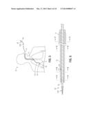 BLEEDING CONTAINMENT DEVICE diagram and image